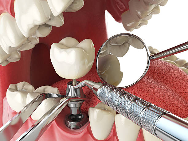 Best Emergency Root Canal Treatment in Laconia, NH